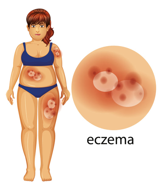 Kisa Eczema ye?